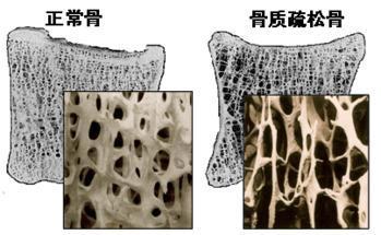 英國的骨質(zhì)疏松癥治療率不再上升