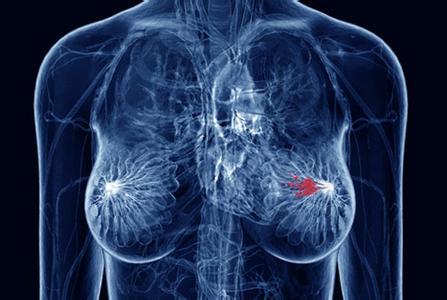 如果手術(shù)前根除腫瘤 HER2+乳腺癌患者的壽命將延長