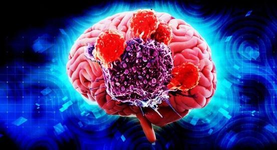 關(guān)鍵的免疫治療目標標志著腦癌中調(diào)節(jié)性T細胞功能異常