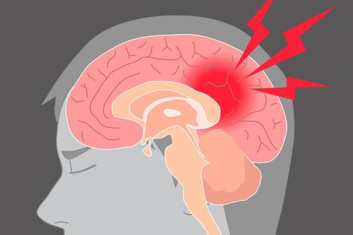 中風(fēng)可能是由大腦大動脈的血塊引起的