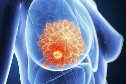 確定了可以預(yù)測(cè)某些類型乳腺癌的新型遺傳特征