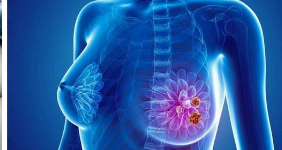 研究性疫苗和免疫療法可以很好地對(duì)抗乳腺癌