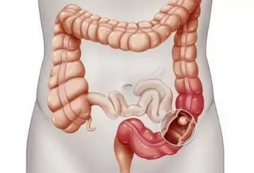 靈活的乙狀結(jié)腸鏡篩查與結(jié)直腸癌發(fā)病率和死亡率的長(zhǎng)期降低相關(guān)