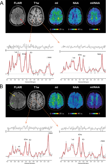 新的 MRI 技術(shù)更早地檢測(cè)到 MS 的大腦變化
