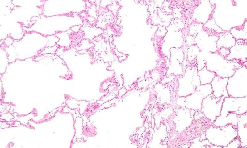 在工作場所接觸殺蟲劑會(huì)增加 COPD 風(fēng)險(xiǎn)
