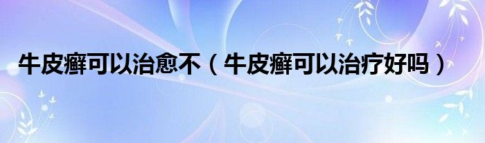 牛皮癬可以治愈不（牛皮癬可以治療好嗎）