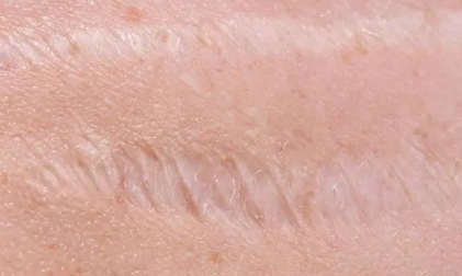 科學家找到防止皮膚疤痕形成的新方法