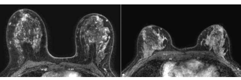 MRI 增強(qiáng)增強(qiáng)有助于表明乳房致密女性的癌癥風(fēng)險(xiǎn)