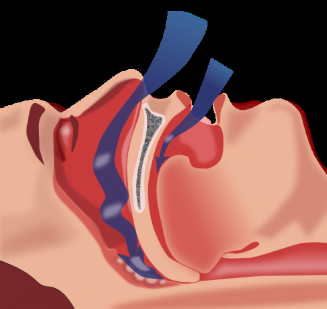 睡眠呼吸暫停與慢性腎病風(fēng)險(xiǎn)增加有關(guān)
