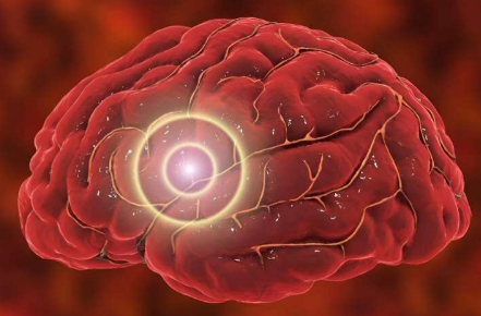 研究發(fā)現(xiàn)中度/重度穿透性 TBI 后患腦癌的風(fēng)險會增加