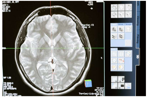 額顳葉癡呆如何改變大腦：研究正在解開(kāi)其遺傳原因