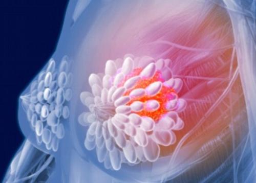 患有過敏性乳房植入物的女性可能會(huì)因癌癥而起訴