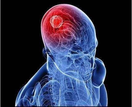 使用新的生物標記物成像可追蹤腫瘤進展對腦癌治療的反應