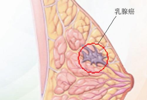 由遺傳主開(kāi)關(guān)控制的乳腺癌